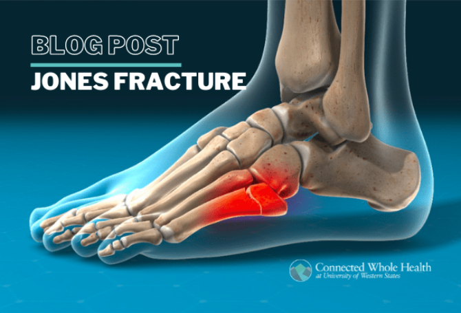 Image for Jones Fracture