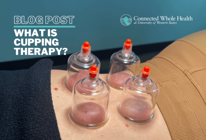 Image for What is Cupping Therapy?
